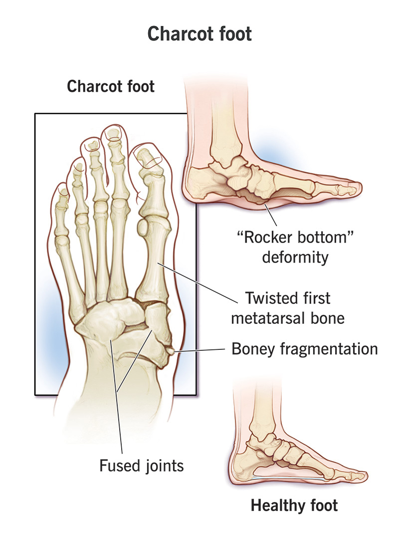 charcot foot treatment in Kolkata