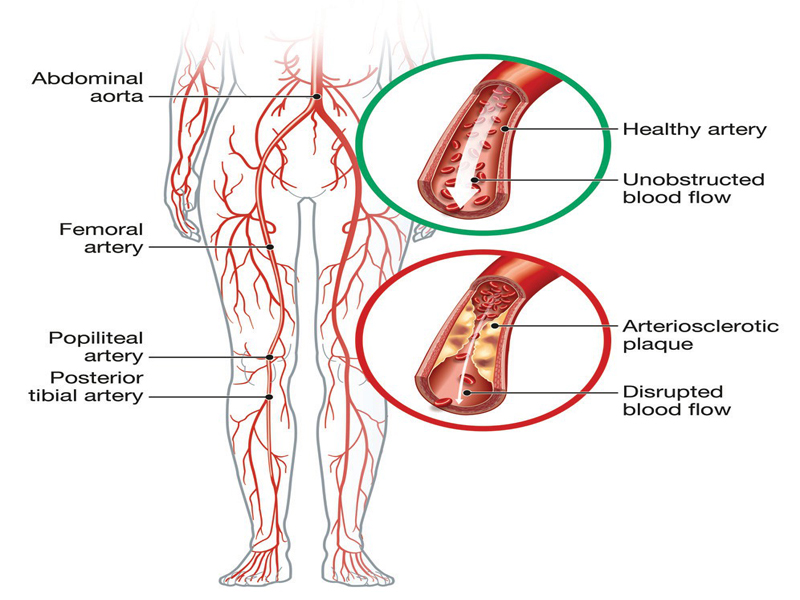 peripheral arterial disease treatment in tamil nadu